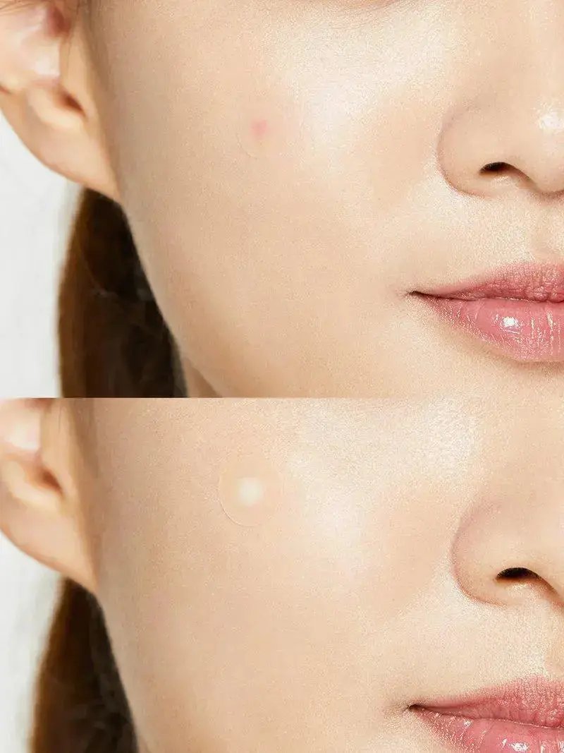 COSRX Acne Pimple Patch COSRX