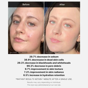 MEDICUBE Red Acne Succinic Acid Peel Serum Medicube